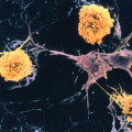 Which cells are affected in multiple sclerosis?