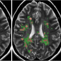 What are the pathological abnormalities in the normal appearing white matter in multiple sclerosis?