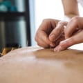 Acupuncture: An Alternative Treatment for MS Symptoms