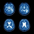 MRI Scans for Diagnosing MS: A Comprehensive Guide