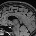 What imaging technique is used for multiple sclerosis?