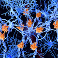 How do the symptoms of ms relate to demyelinated neurons?