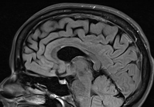 Does multiple sclerosis always show up on mri?