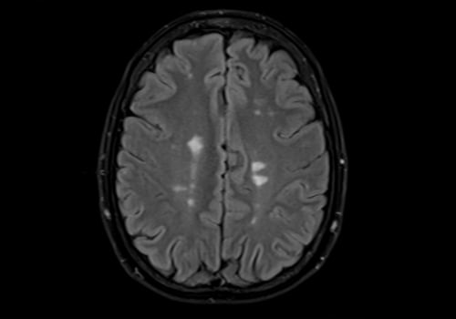 Are there different types of sclerosis?