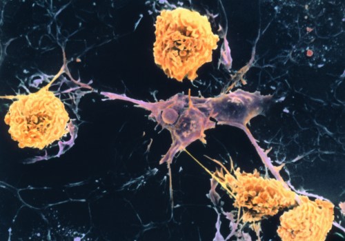 Which cells are affected in multiple sclerosis?