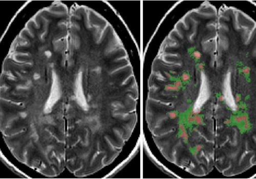 What are the pathological abnormalities in the normal appearing white matter in multiple sclerosis?