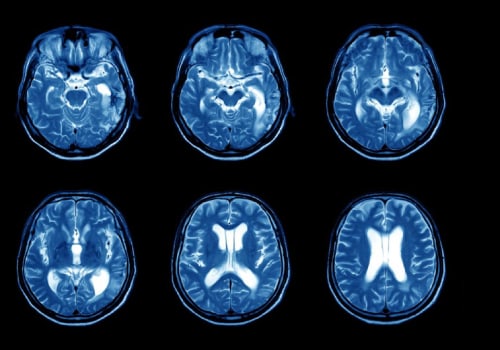 MRI Scans for Diagnosing MS: A Comprehensive Guide
