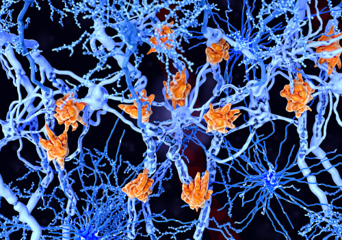 How do the symptoms of ms relate to demyelinated neurons?